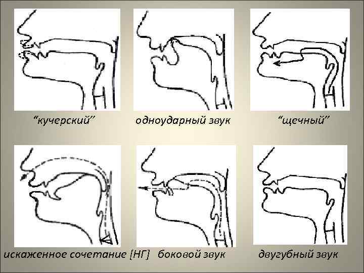 “кучерский” одноударный звук искаженное сочетание [НГ] боковой звук “щечный” двугубный звук 