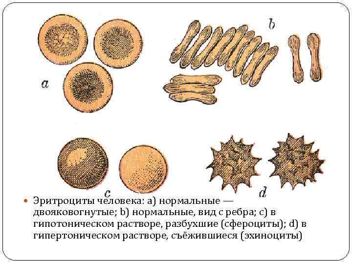  Эритроциты человека: a) нормальные — двояковогнутые; b) нормальные, вид с ребра; c) в