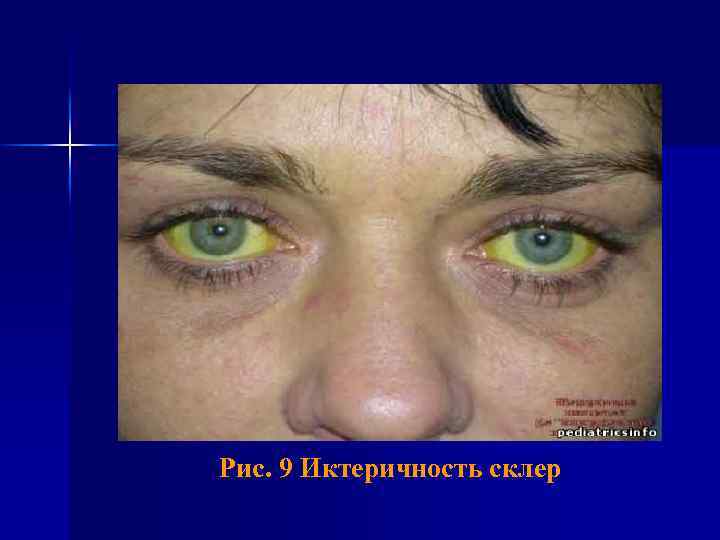 Рис. 9 Иктеричность склер 