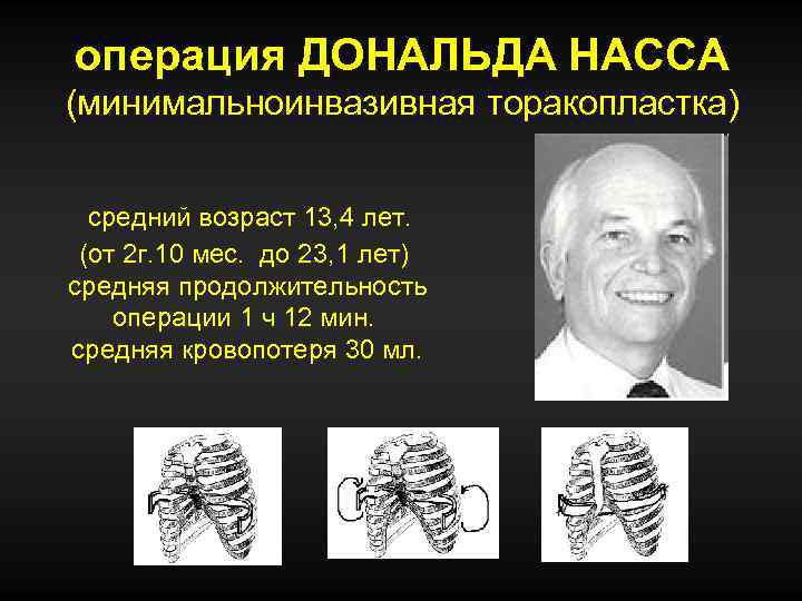 операция ДОНАЛЬДА НАССА (минимальноинвазивная торакопластка) средний возраст 13, 4 лет. (от 2 г. 10