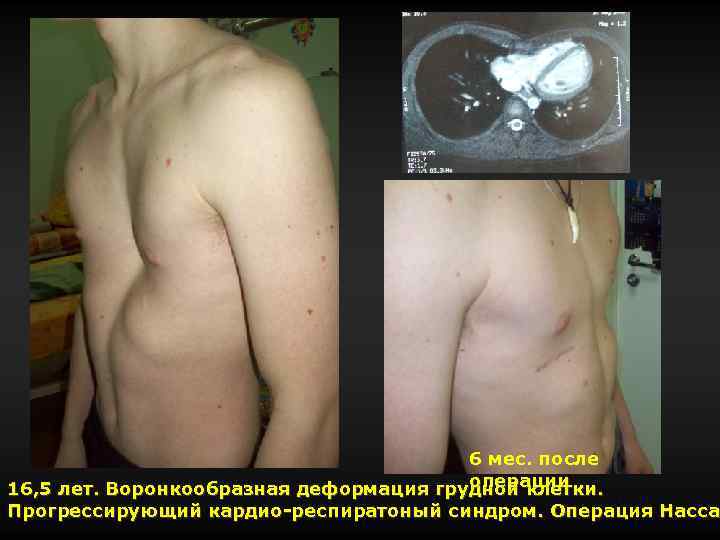 6 мес. после операции 16, 5 лет. Воронкообразная деформация грудной клетки. Прогрессирующий кардио-респиратоный синдром.