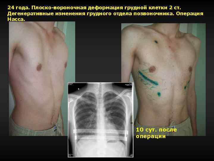 24 года. Плоско-вороночная деформация грудной клетки 2 ст. Дегенеративные изменения грудного отдела позвоночника. Операция