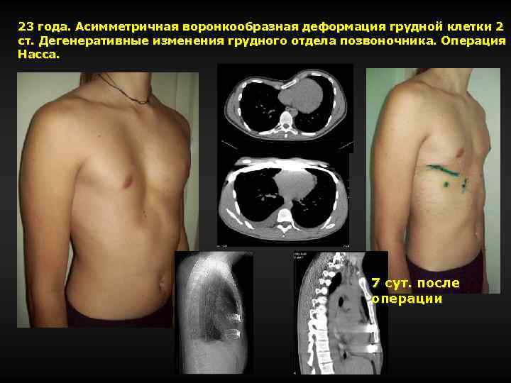 Врожденная деформация грудной клетки