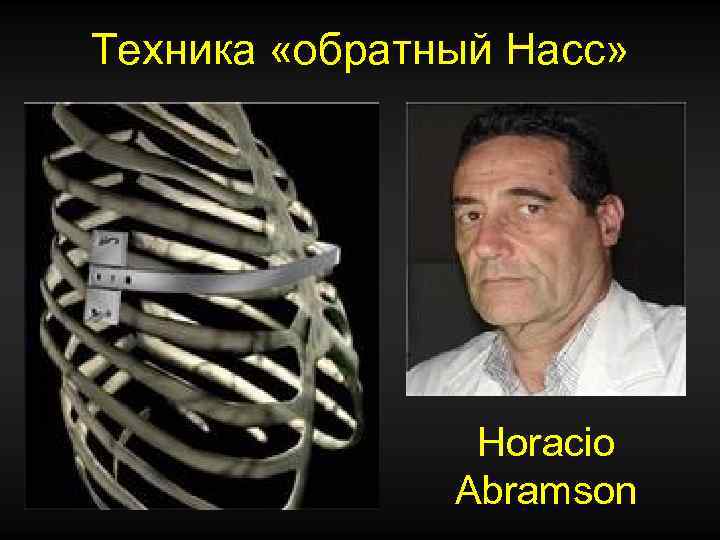 Техника «обратный Насс» Horacio Abramson 