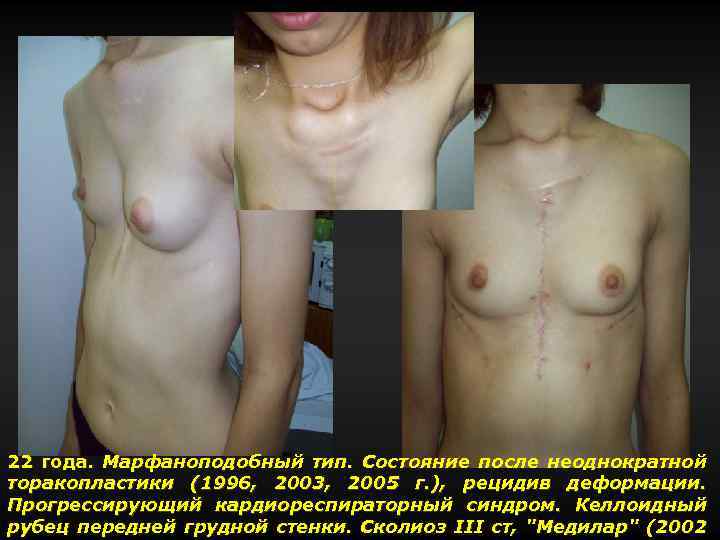 22 года. Марфаноподобный тип. Состояние после неоднократной торакопластики (1996, 2003, 2005 г. ), рецидив