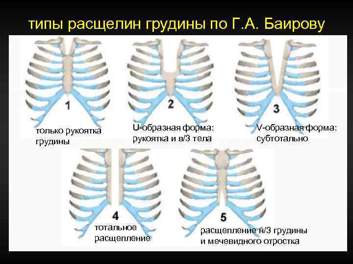 типы расщелин грудины по Г. А. Баирову только рукоятка грудины U-образная форма: рукоятка и