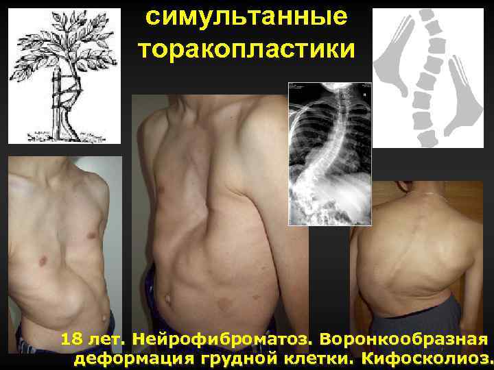 симультанные торакопластики 18 лет. Нейрофиброматоз. Воронкообразная деформация грудной клетки. Кифосколиоз. 