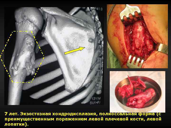 7 лет. Экзостозная хондродисплазия, полиоссальная форма (с преимущественным поражением левой плечевой кости, левой лопатки).