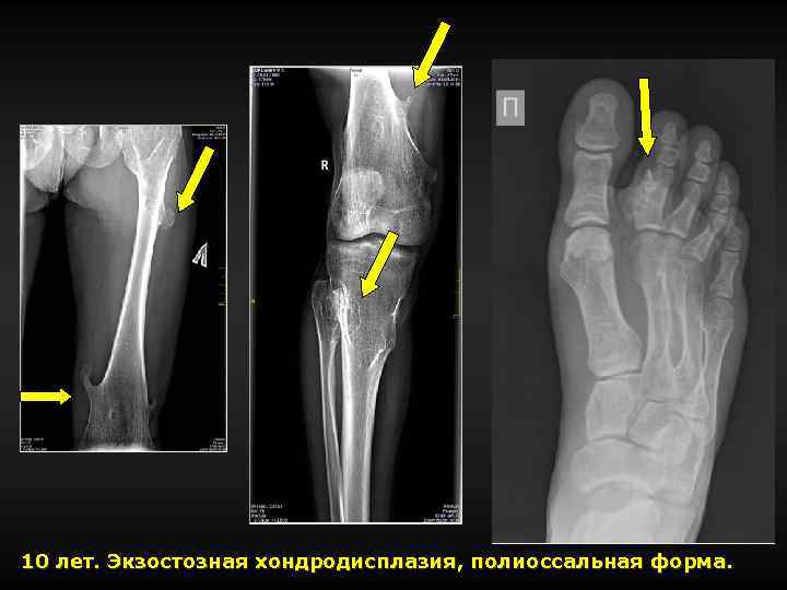 10 лет. Экзостозная хондродисплазия, полиоссальная форма. 