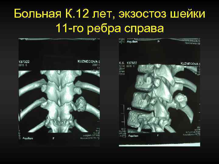 Больная К. 12 лет, экзостоз шейки 11 -го ребра справа 