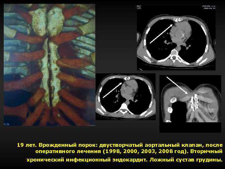 19 лет. Врожденный порок: двустворчатый аортальный клапан, после оперативного лечения (1998, 2000, 2003, 2008
