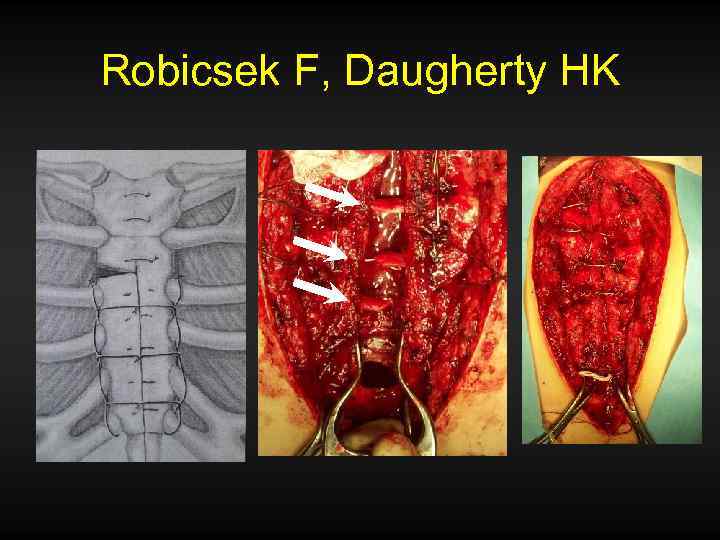 Robicsek F, Daugherty HK 