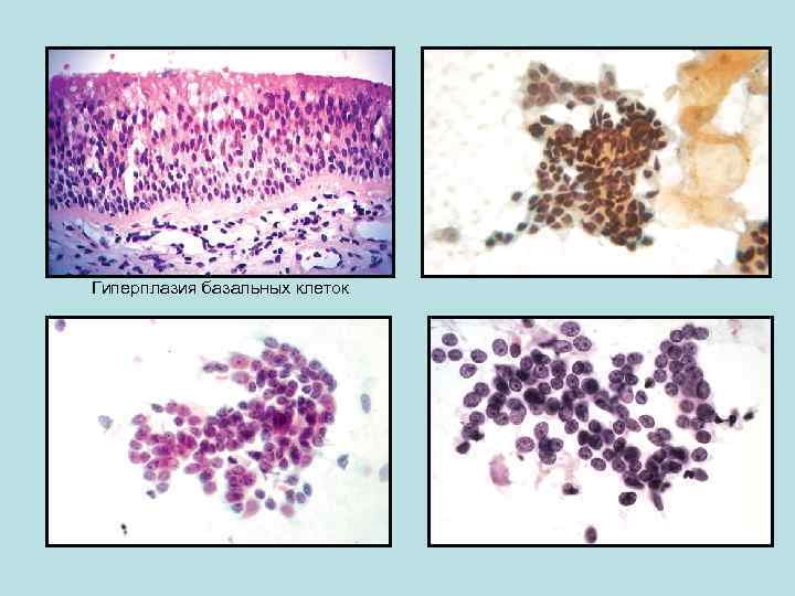 Гиперплазия базальных клеток 