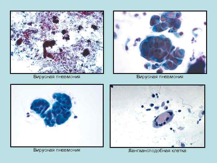 Вирусная пневмония Лангхансподобная клетка 
