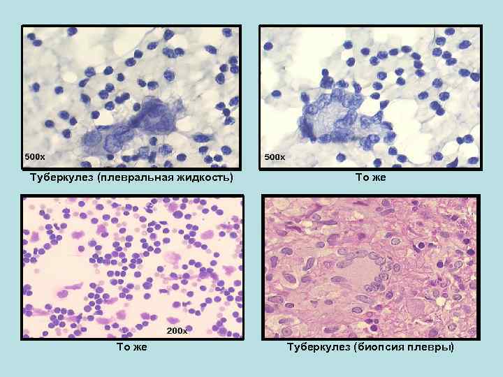 Туберкулез (плевральная жидкость) То же Туберкулез (биопсия плевры) 
