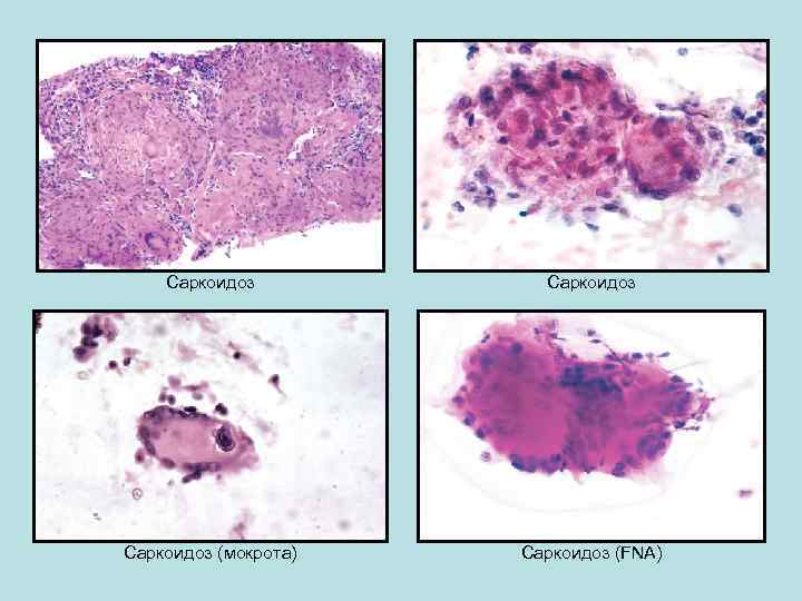 Саркоидоз (мокрота) Саркоидоз (FNA) 