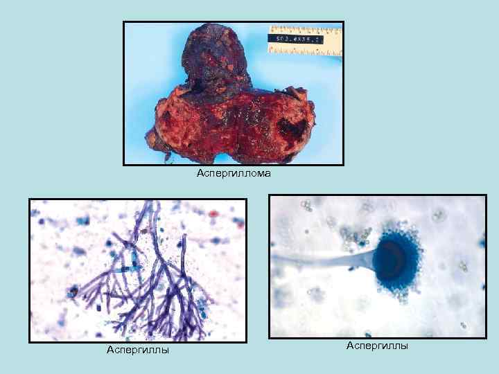 Аспергиллома Аспергиллы 