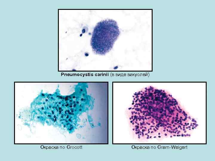 Pneumocystis carinii (в виде вакуолей) Окраска по Grocott Окраска по Gram-Weigert 