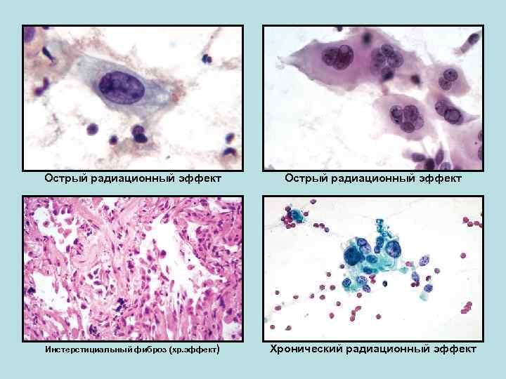 Острый радиационный эффект Инстерстициальный фиброз (хр. эффект) Хронический радиационный эффект 