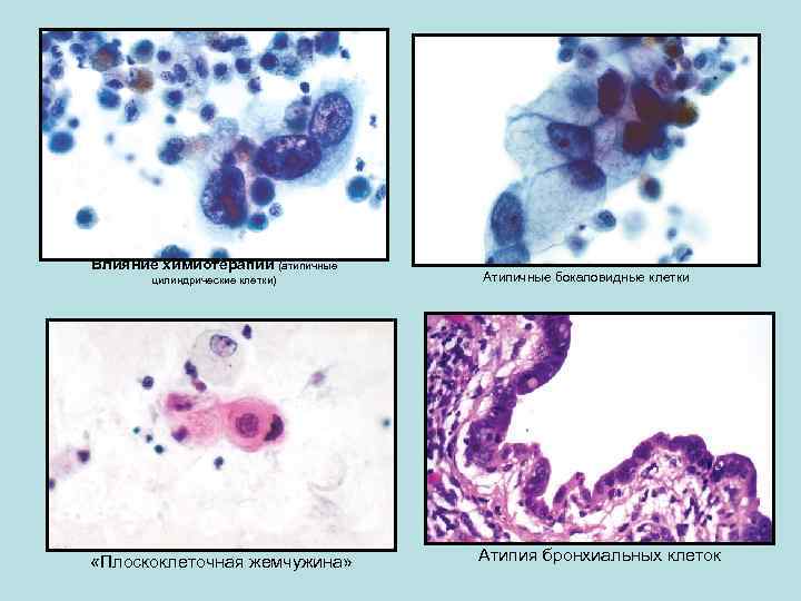 Влияние химиотерапии (атипичные цилиндрические клетки) «Плоскоклеточная жемчужина» Атипичные бокаловидные клетки Атипия бронхиальных клеток 