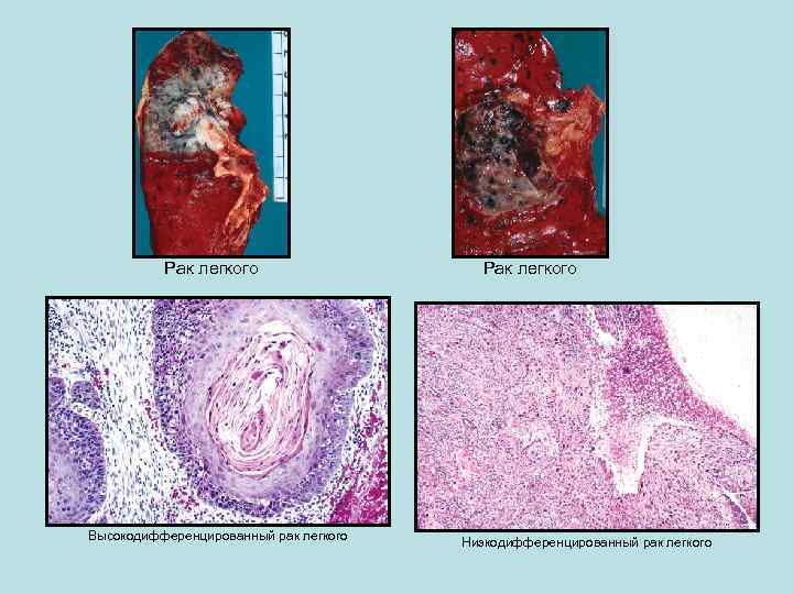 Рак легкого Высокодифференцированный рак легкого Рак легкого Низкодифференцированный рак легкого 