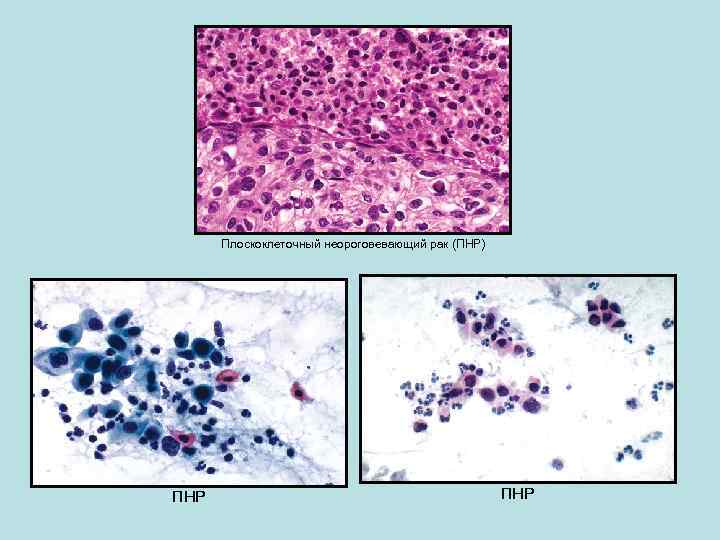 Плоскоклеточный неороговевающий рак (ПНР) ПНР 