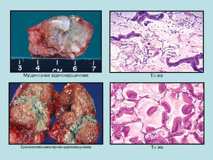 Муцинозная аденокарцинома То же Бронхиолоальвеолярная аденокарцинома То же 