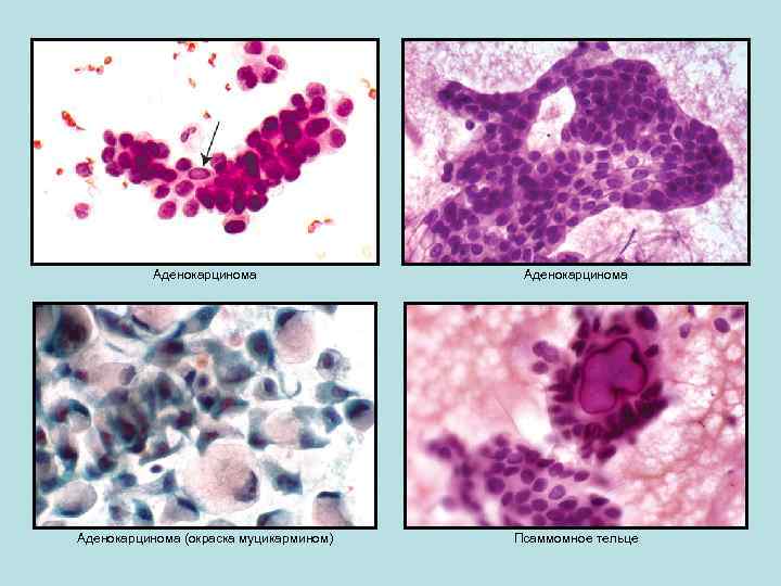 Аденокарцинома (окраска муцикармином) Псаммомное тельце 