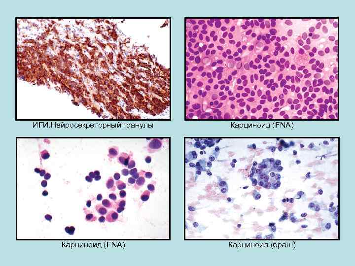 ИГИ. Нейросекреторный гранулы Карциноид (FNA) Карциноид (браш) 