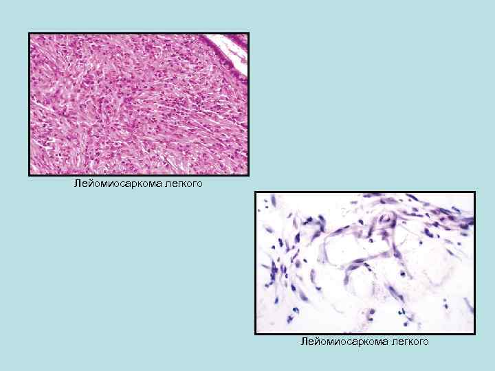 Лейомиосаркома легкого 