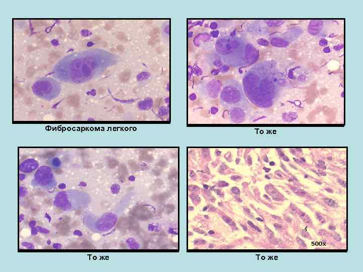 Фибросаркома легкого То же 