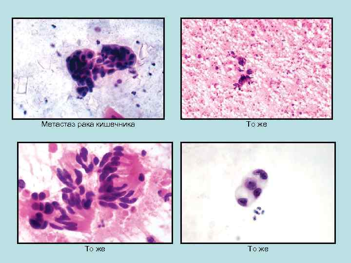 Метастаз рака кишечника То же 