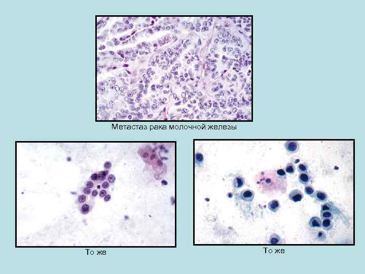 Метастаз рака молочной железы То же 