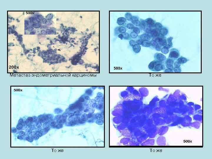 Метастаз эндометриальной карциномы То же 
