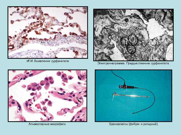 ИГИ. Выявление сурфанктата Альвеолярные макрофаги. Электроннограмма. Предшественник сурфанктата. Бронхоскопы (фибро- и ригидный) 
