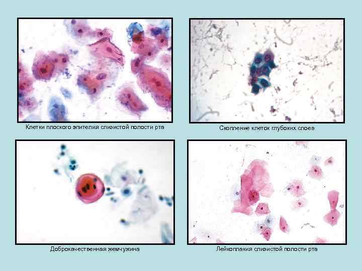 Клетки плоского эпителия слизистой полости рта Скопление клеток глубоких слоев Доброкачественная жемчужина Лейкоплакия слизистой