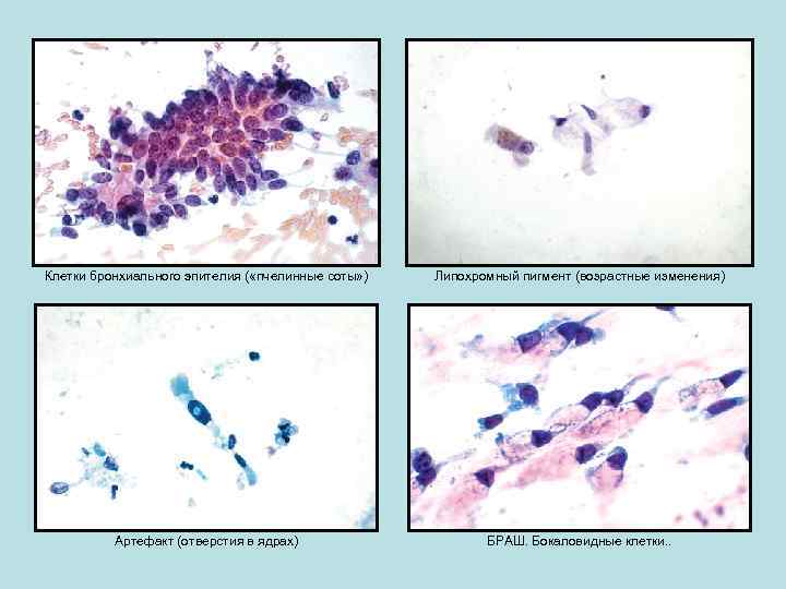 Клетки бронхиального эпителия ( «пчелинные соты» ) Липохромный пигмент (возрастные изменения) Артефакт (отверстия в
