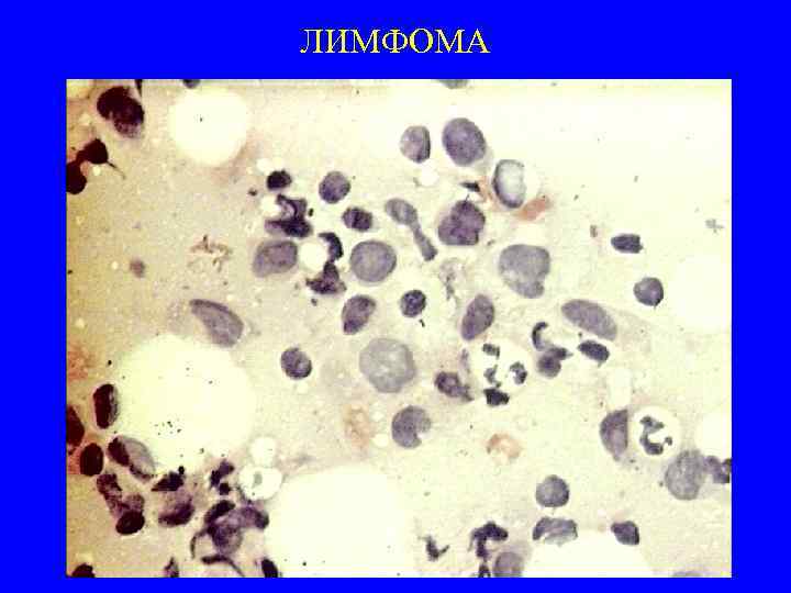 ЛИМФОМА 
