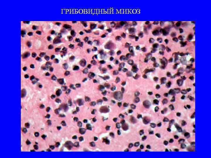 ГРИБОВИДНЫЙ МИКОЗ 