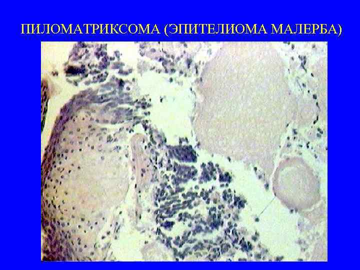 ПИЛОМАТРИКСОМА (ЭПИТЕЛИОМА МАЛЕРБА) 