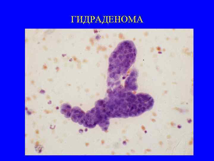 ГИДРАДЕНОМА 