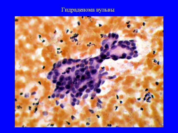 Гидраденома вульвы 