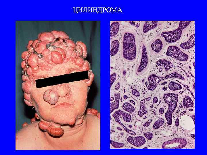 ЦИЛИНДРОМА 