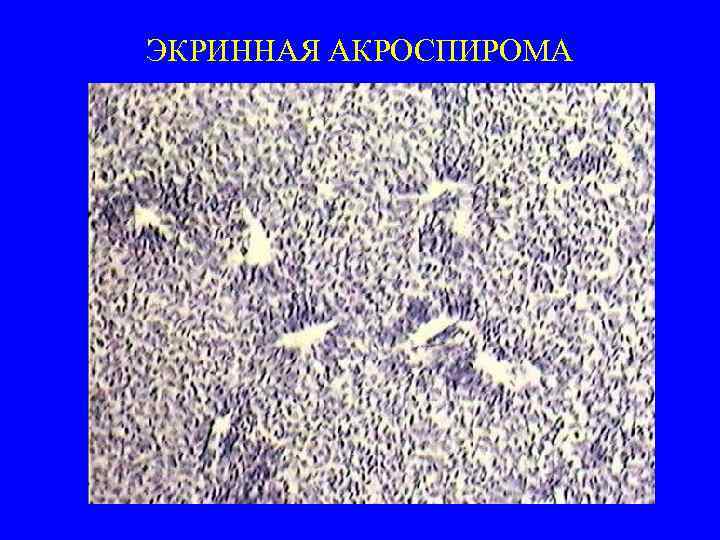 ЭКРИННАЯ АКРОСПИРОМА 