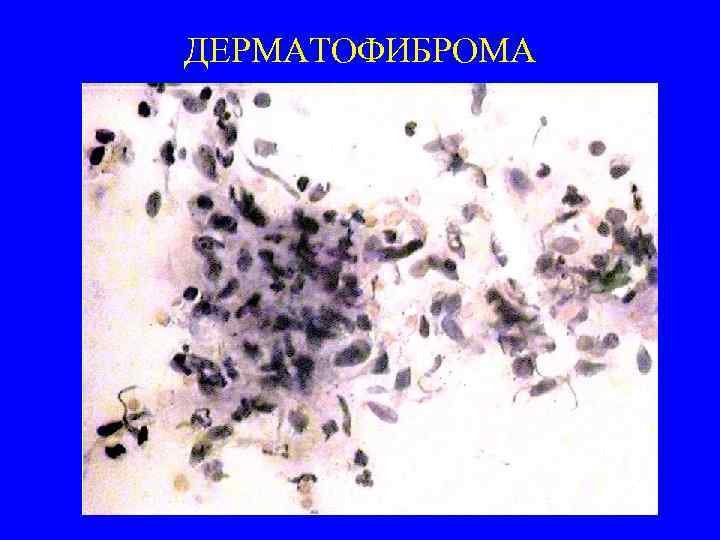 ДЕРМАТОФИБРОМА 