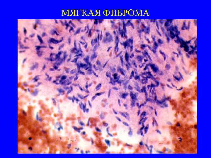 МЯГКАЯ ФИБРОМА 