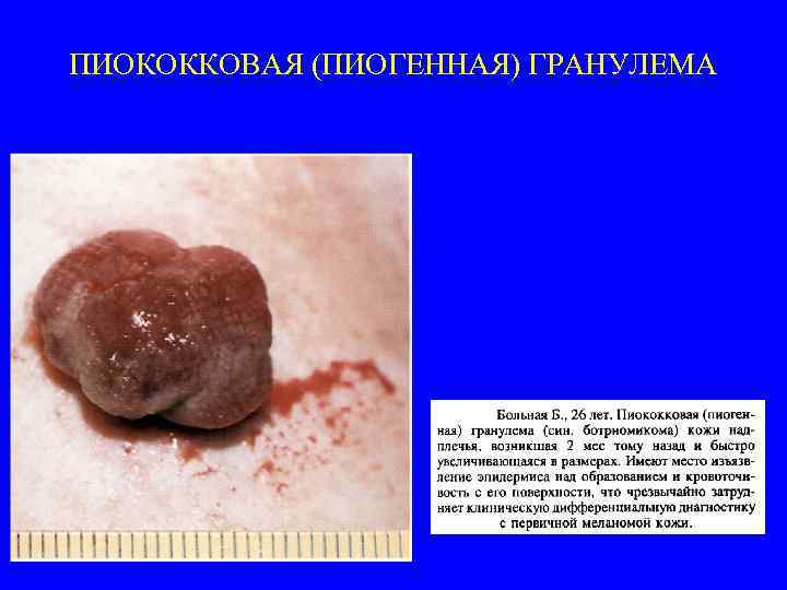 ПИОКОККОВАЯ (ПИОГЕННАЯ) ГРАНУЛЕМА 