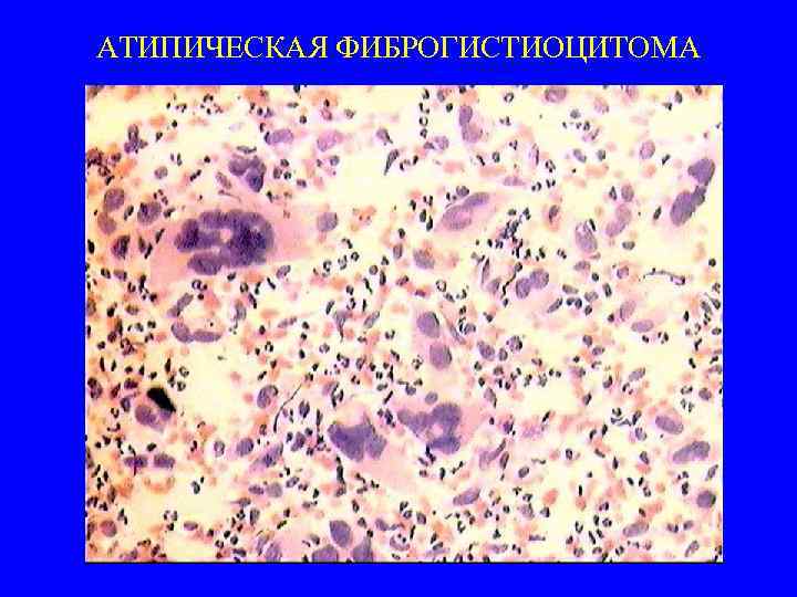 АТИПИЧЕСКАЯ ФИБРОГИСТИОЦИТОМА 