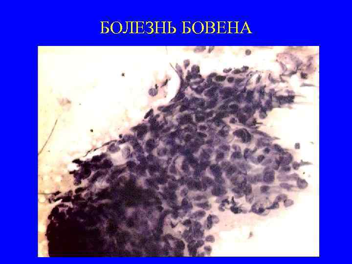 БОЛЕЗНЬ БОВЕНА 