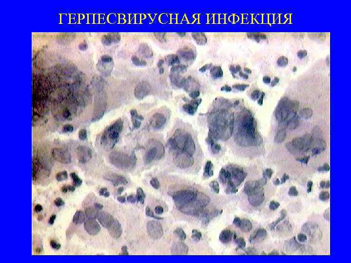 ГЕРПЕСВИРУСНАЯ ИНФЕКЦИЯ 